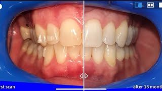 Invisalign treatment before and after with Virtual tracking time lapse [upl. by Ramsey516]