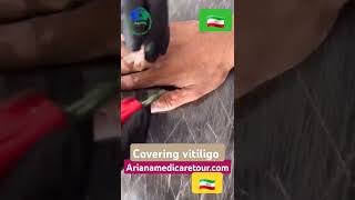 Vitiligo covering علاج البهاق والبرص [upl. by Vareck288]