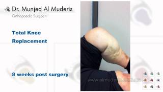 Total Knee Replacement  8 weeks post surgery [upl. by Suhail]