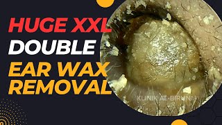 HUGE XXL Double Earwax Removal Legendary Satisfying Level [upl. by Cyb]