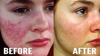 How I Cleared My Hyperpigmentation and Acne Marks At Home [upl. by Elatnahs]