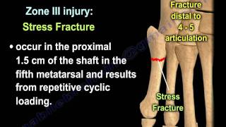 Proximal Fifth Metatarsal Fractures  Everything You Need To Know  Dr Nabil Ebraheim [upl. by Hufnagel]