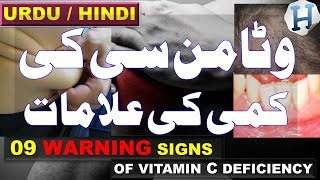 Vitamin C Benefits  Vitamin C Deficiency Symptoms amp Vitamin C Rich Foods  Health Tips Urdu Hindi [upl. by Aiksa360]