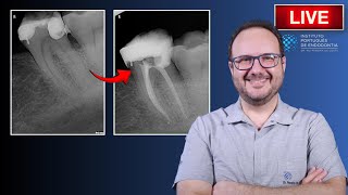 Endo Tx of 🦷37 with Irreversible Pulpitis amp Condensing Osteitis ▶️ Part 2  CASE164 [upl. by Rickie558]