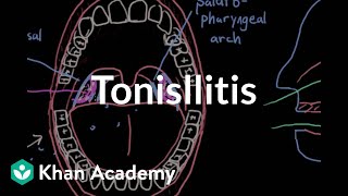 Tonsillitis  Respiratory system diseases  NCLEXRN  Khan Academy [upl. by Kimmi480]