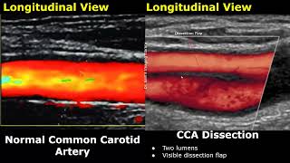 Carotid Artery ColorSpectral Doppler Ultrasound Normal Vs Abnormal Images  ICA Stenosis USG [upl. by Eerased]