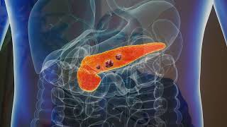 Pancreatic Cancer By Dr Rakesh Rai Consultant Hepato Pancrato Biliary Surgeon Dubai UAE [upl. by Bram]