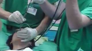 Awake Intubation [upl. by Ahseenyt]