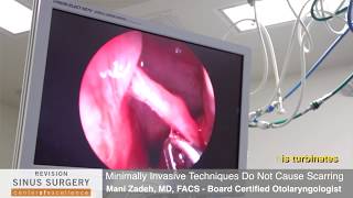 Septoplasty To Correct Chronic Sinusitis  3102860123 [upl. by Johan]