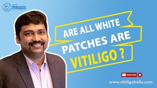 All white patches are not vitiligo  Understanding Vitiligo  Dr A P Holla  MelanoSite [upl. by Melda]