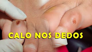 CALO NO DEDO DO PÉ  Vipé Podologia [upl. by Circosta471]