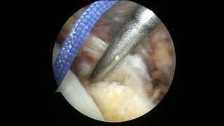 biceps rerouting 5  Medial Fixation of the LHBT to new groove [upl. by Nani]