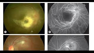 Kanski Clinical Ophthalmology Easy  Uveitis 3 [upl. by Haukom]