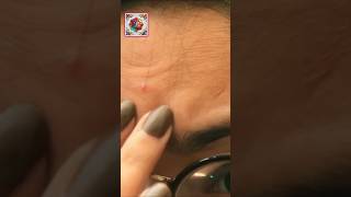 pimple tips acne tips pimple ko dur Karne ka tarika 😞 [upl. by Sou]