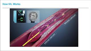 Intravascular Lithotripsy and its Application in Iliac Disease with Dr Ehrin J Armstrong [upl. by Ettezzil]