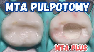 MTA PULPOTOMY 🟡 Pulpotomy with MTA PLUS 🟢 Step By Step [upl. by Namijneb]