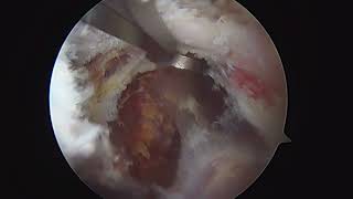 Arthroscopic ACJ stabilization and Bankart repair [upl. by Omer85]