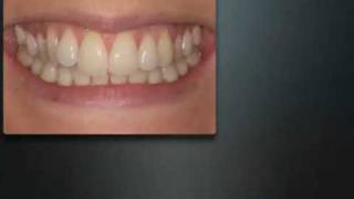 Inman Aligner before and after [upl. by Dloreh]