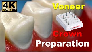 Veneer and Crown Prep StepbyStep [upl. by Nolaf]