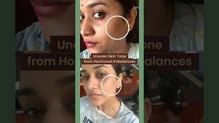 Indulekha Soap  For my uneven skin tone in just 4 weeks  Parvathy R Krishna [upl. by Iney650]