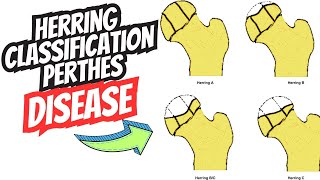 Herring Lateral Piller Classification of LeggCalvèPerthes Disease [upl. by Naud]