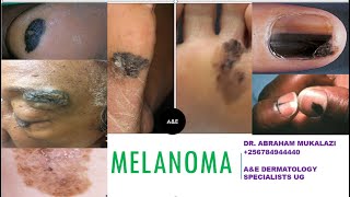 UPDATES ON MELANOMA BY DR ABRAHAM SKINCANCER education dermatology [upl. by Eugirne]