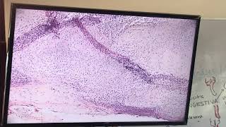 Tuberculosis ganglionar [upl. by Stroup]