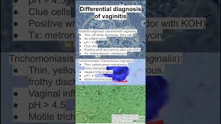 Differential diagnosis of vaginitis [upl. by Yluj]