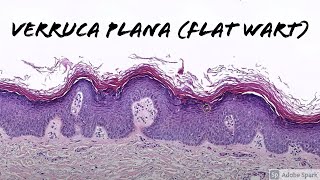 Verruca Plana Flat Wart under the microscope 5Minute Pathology Pearls [upl. by Lula]