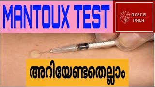 Mantoux Test  Tuberculin Skin Test TST Malayalam [upl. by Emelda267]