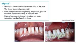 Expasyl  A perfect process for gingival retraction [upl. by Moreta]