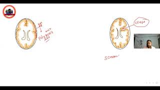 neuronalmigrationdefect porencephaly schizencephaly lissencephaly [upl. by Nagad799]