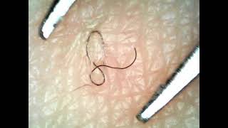 Oddly satisfying Ingrown hair removal [upl. by Yesoj945]