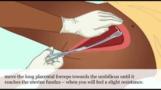 Postpartum IUD A Practical Guide [upl. by Adrianna]