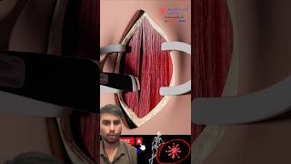 TRACHEOTOMY Procedure 3D ANIMATION gameplay animation [upl. by Eilsel]