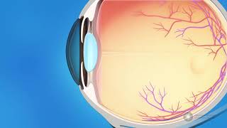 What is glaucoma [upl. by Inilam]