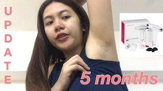 5 MONTHS USING DIY PERMANENT HAIR REMOVAL in my Underarm update video [upl. by Ettezoj]