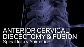 C56C67 Anterior Cervical Discectomy with Fusion [upl. by Connett784]