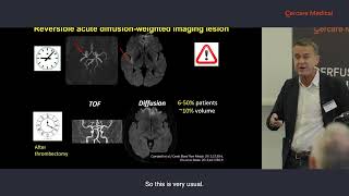 Prof Yves Berthezène Advancements in Stroke MRI Unveiling the Role of Perfusion in 2024 [upl. by Vern]