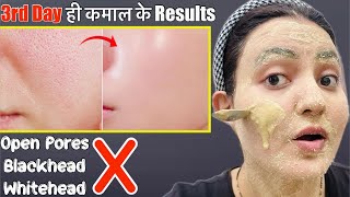 Glass Skin Transformation Series Day 3  Remove Open Pores Blackhead Whitehead in 5 Days💕 [upl. by Raskin238]