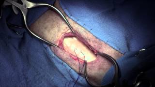 Tracheotomy with tracheostomy tube placement in dogs [upl. by Wing]