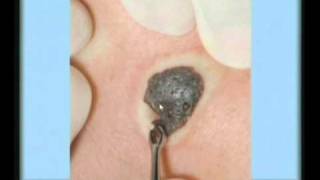 Seborrheic Keratosis Treatment [upl. by Aidan]