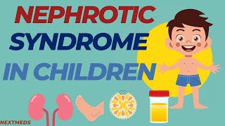 Nephrotic Syndrome In ChildrenCausesSigns And SymptomsDiagnosisTreatmentPaediatrics [upl. by Susanetta]