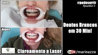 PodeSorrir Episódio 3 Clareamento a Laser Em meia hora dentes branquinhos [upl. by Lanfri403]