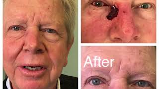 Eyelid Skin Cancer Reconstruction Surgery [upl. by Murrah]