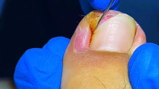 Huge Ingrown Toenail Removal by Top Podiatrist [upl. by Vanthe]