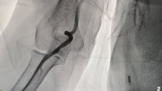 Brachial Loop Case 3 [upl. by Ravert]