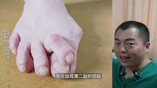 hallux valgus 拇外翻的发展进程，仰趾锤状趾畸形 [upl. by Radburn]