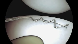 Sequential Meniscal Running Stitch Using Sequent®  CONMED Animation [upl. by Camm]