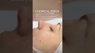 Which is better for Melasma Lasers vs Peels  Ensoul Medical Clinic [upl. by Oehsen999]